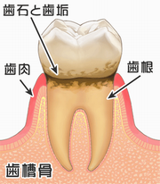 臼歯歯肉炎