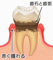 臼歯軽度歯周炎