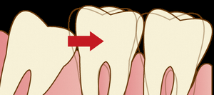 親知らず歯ならび影響
