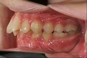 写真：上顎前突