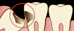 イラスト：むし歯になってしまった親知らず