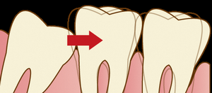 イラスト：歯ならびに影響を及ぼす親知らず