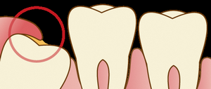 イラスト：歯の一部分だけが見えている親知らず